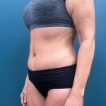 Tummy Tuck Before & After Patient #3315