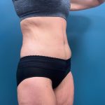 Tummy Tuck Before & After Patient #3315