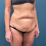 Tummy Tuck Before & After Patient #3315