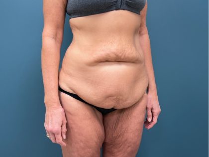 Tummy Tuck Before & After Patient #3315