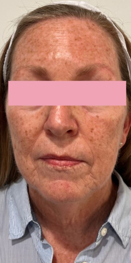 BroadBand Light Therapy (BBL) Before & After Patient #3322