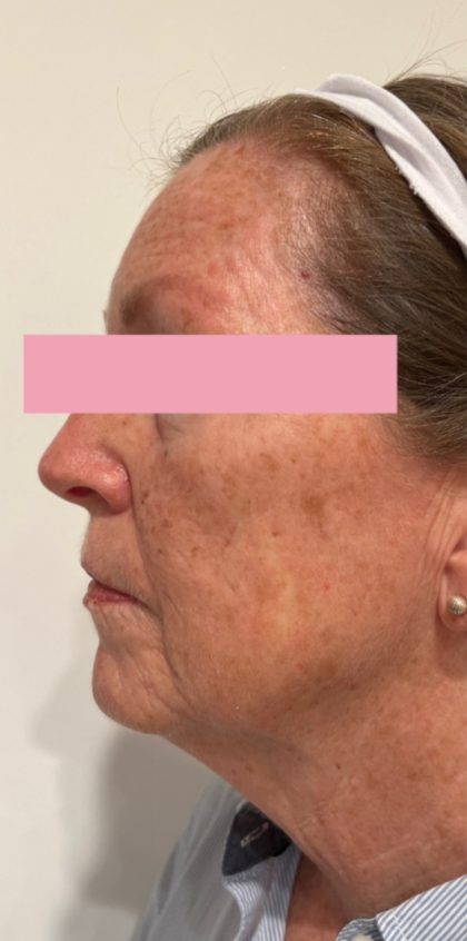 BroadBand Light Therapy (BBL) Before & After Patient #3322