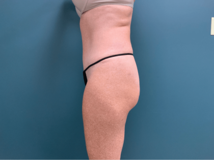 Tummy Tuck Before & After Patient #3357