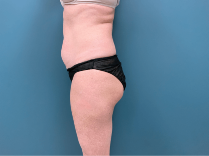 Tummy Tuck Before & After Patient #3357