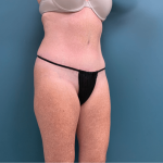 Tummy Tuck Before & After Patient #3357