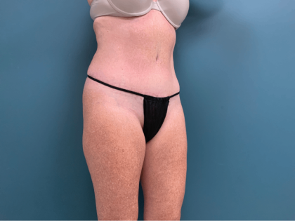 Tummy Tuck Before & After Patient #3357