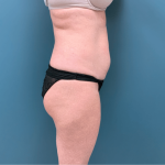 Tummy Tuck Before & After Patient #3357