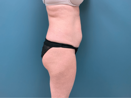 Tummy Tuck Before & After Patient #3357