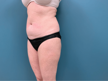 Tummy Tuck Before & After Patient #3357