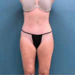 Tummy Tuck Before & After Patient #3357