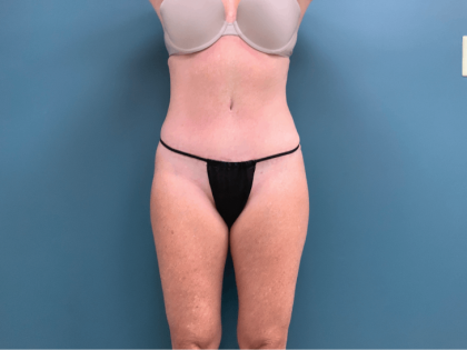 Tummy Tuck Before & After Patient #3357