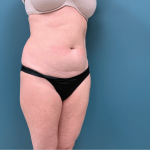 Tummy Tuck Before & After Patient #3357