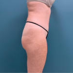 Tummy Tuck Before & After Patient #3357