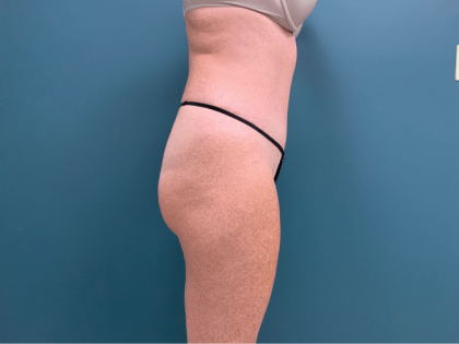 Tummy Tuck Before & After Patient #3357