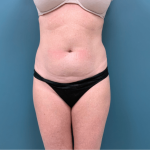 Tummy Tuck Before & After Patient #3357