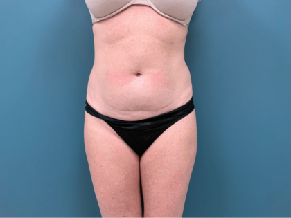 Tummy Tuck Before & After Patient #3357