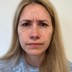 Botox/Dysport Before & After Patient #3423