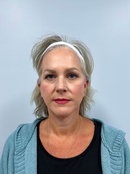 Facelift Before & After Patient #3391