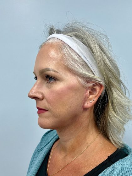 Facelift Before & After Patient #3391