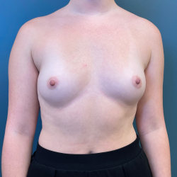 Breast Augmentation Before & After Patient #3449