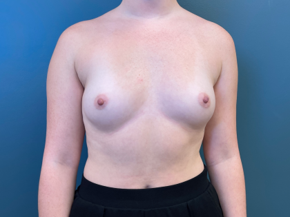 Breast Augmentation Before & After Patient #3449