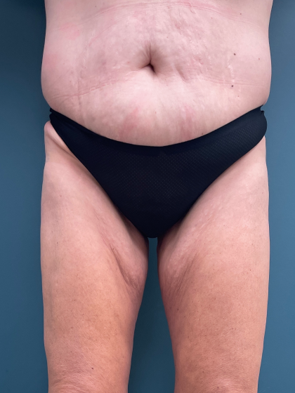 Thigh Lift Before & After Patient #3446