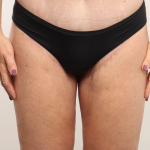 Thigh Lift Before & After Patient #3446