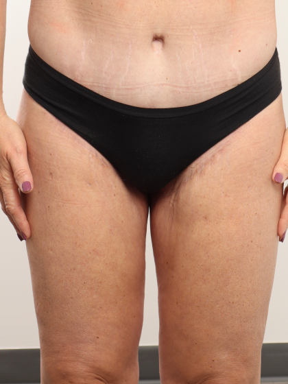 Thigh Lift Before & After Patient #3446