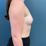 Breast Augmentation Before & After Patient #3449