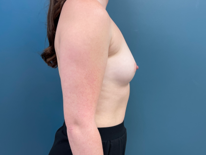 Breast Augmentation Before & After Patient #3449