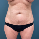 Tummy Tuck Before & After Patient #3565