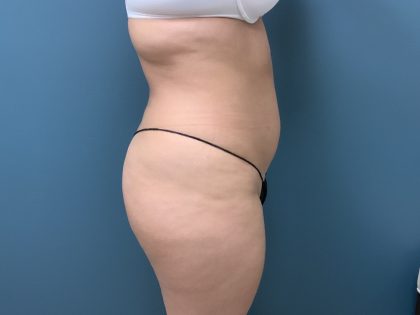 Brazilian Butt Lift Before & After Patient #3585