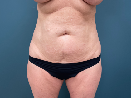 Tummy Tuck Before & After Patient #3565