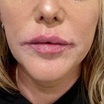 Kysse Lip Filler Before & After Patient #3550