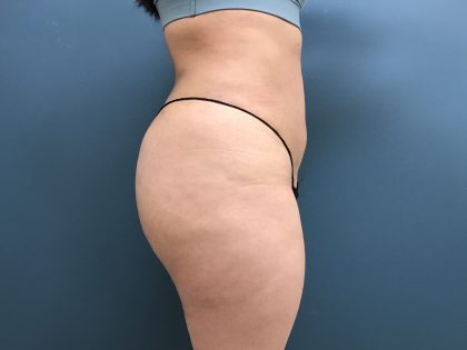 Brazilian Butt Lift Before & After Patient #3585