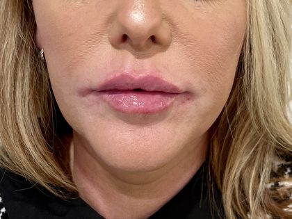 Kysse Lip Filler Before & After Patient #3550