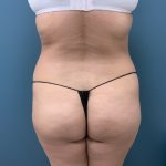 Brazilian Butt Lift Before & After Patient #3585