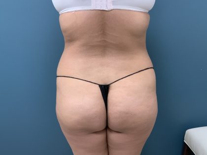 Brazilian Butt Lift Before & After Patient #3585