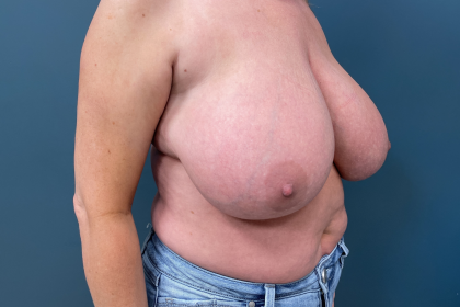 Breast Reduction Before & After Patient #3608