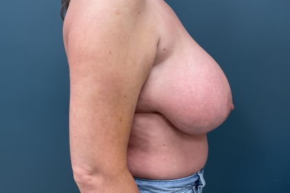 Breast Reduction Before & After Patient #3608