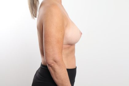 Breast Augmentation Before & After Patient #3553