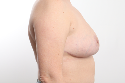 Breast Reduction Before & After Patient #3608