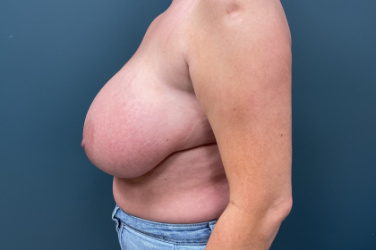 Breast Reduction Before & After Patient #3608