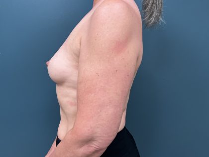 Breast Augmentation Before & After Patient #3553