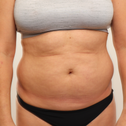 Liposuction Before & After Patient #3647