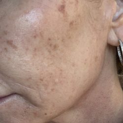 BroadBand Light Therapy (BBL) Before & After Patient #3671