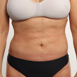 Liposuction Before & After Patient #3647