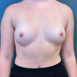 Breast Augmentation Before & After Patient #3638