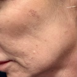 BroadBand Light Therapy (BBL) Before & After Patient #3671