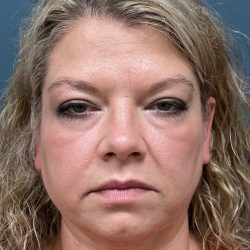 Fillers and Injectables Before & After Patient #3693